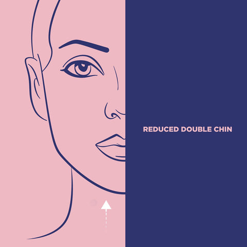STRIP Thermal face lift to improve double chin