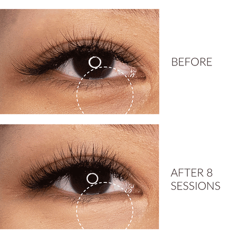 Browhaus Plasma Eye Lift Before and After results in 8 weeks