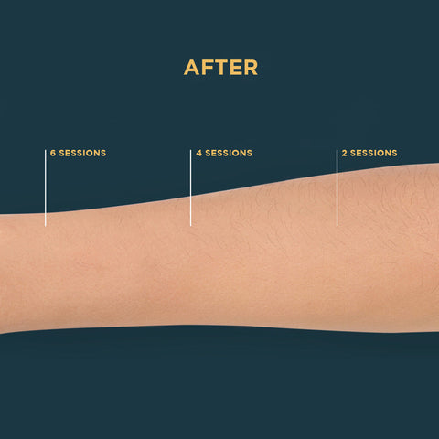 Strip AFT Hair removal results